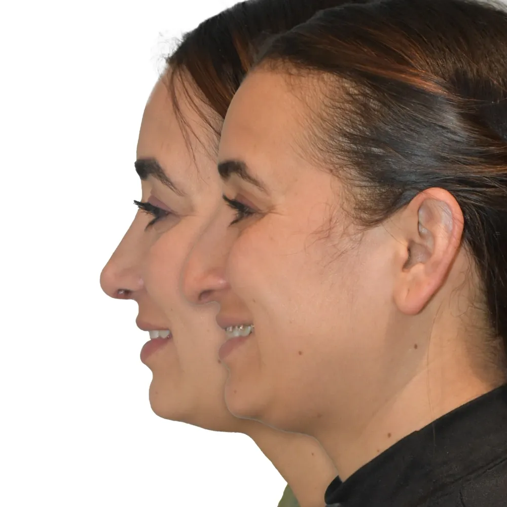 Rinoplastia cerrada resultado · Paciente 5