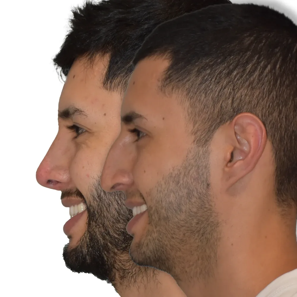Rinoplastia cerrada resultado · Paciente 6