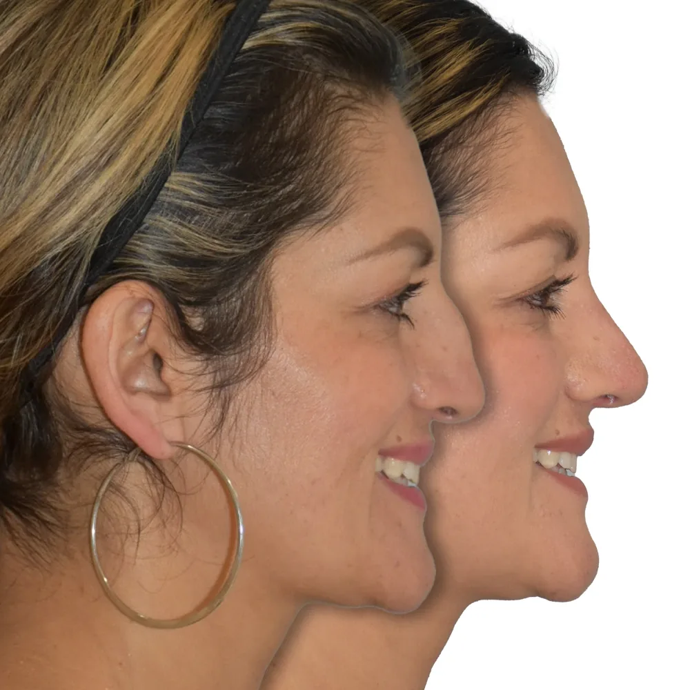 Rinoplastia cerrada resultado · Paciente 4
